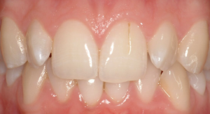 Correcting rotations with composite veneers.